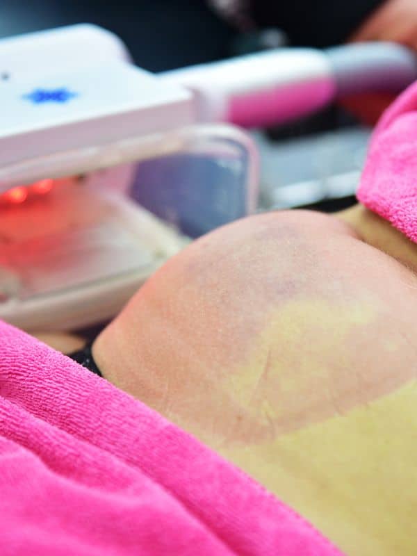 Cryolipolyse chez Beauty Time (1) Cryolipolyse chez Beauty Time 1